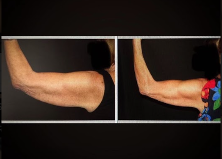 Emsculpt NEO Before & After 12