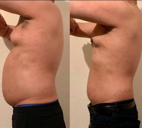 Emsculpt NEO Before & After 15