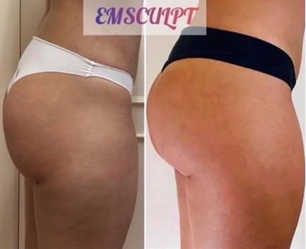 Emsculpt NEO Before & After 16
