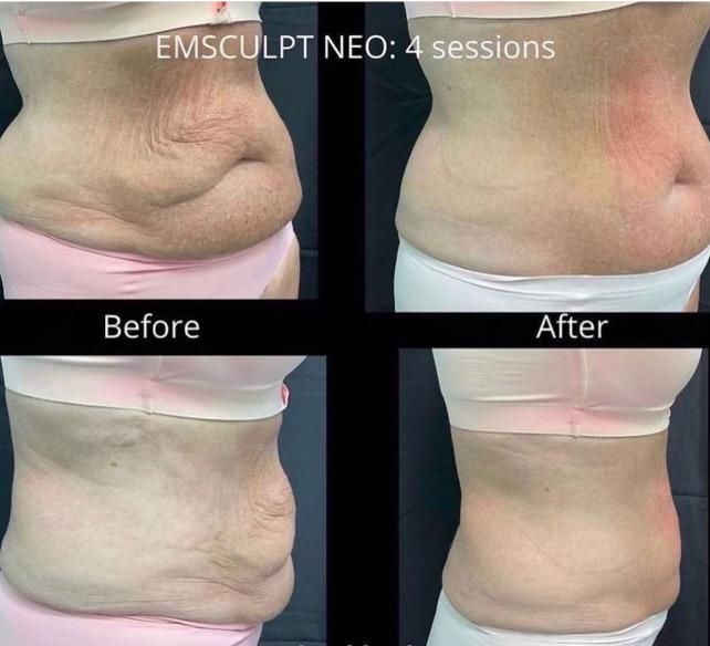 Emsculpt NEO Before & After 17