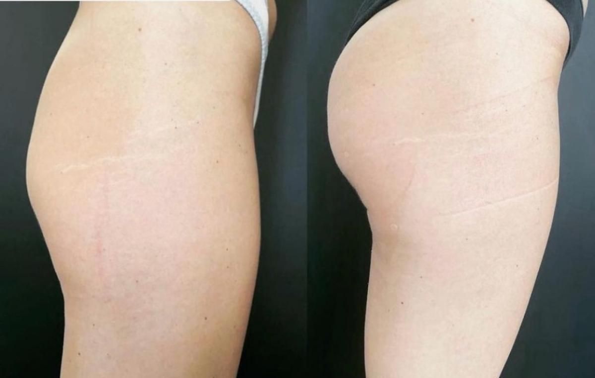 Emsculpt NEO Before & After 18