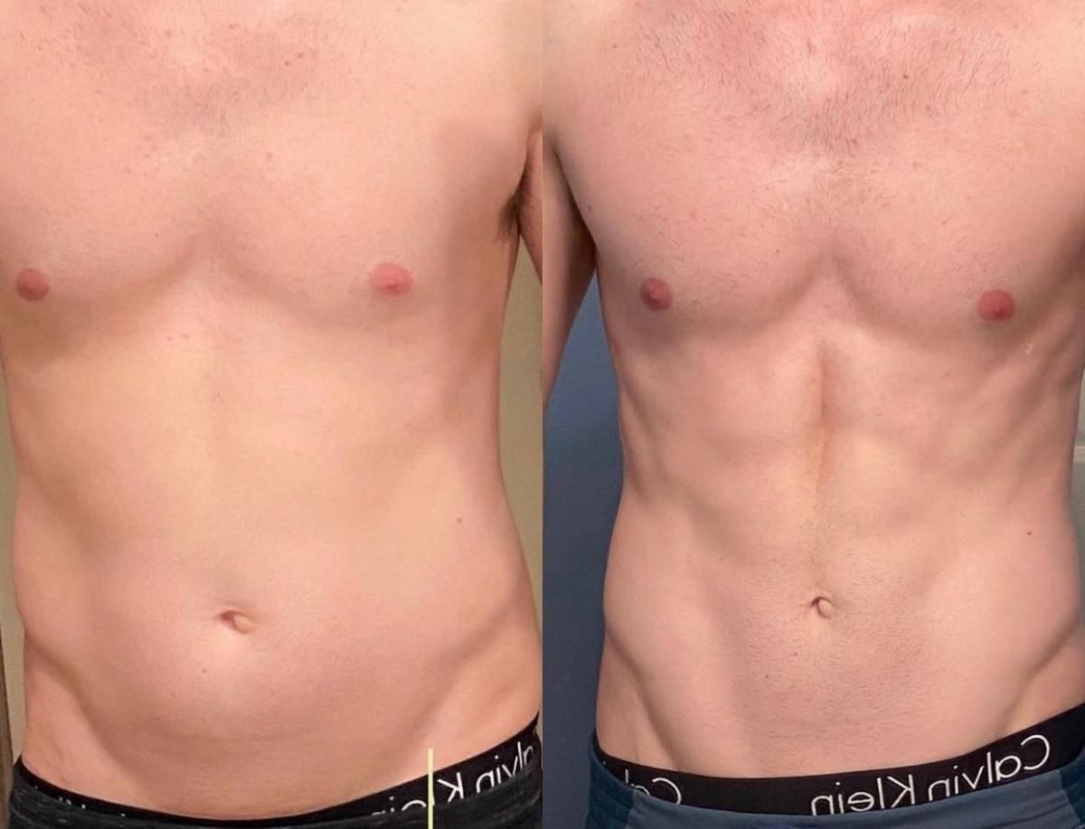 Emsculpt NEO Before & After 19