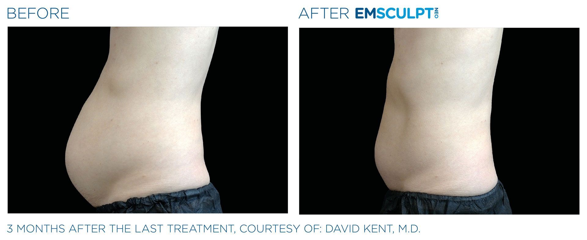 Emsculpt NEO Before & After 2