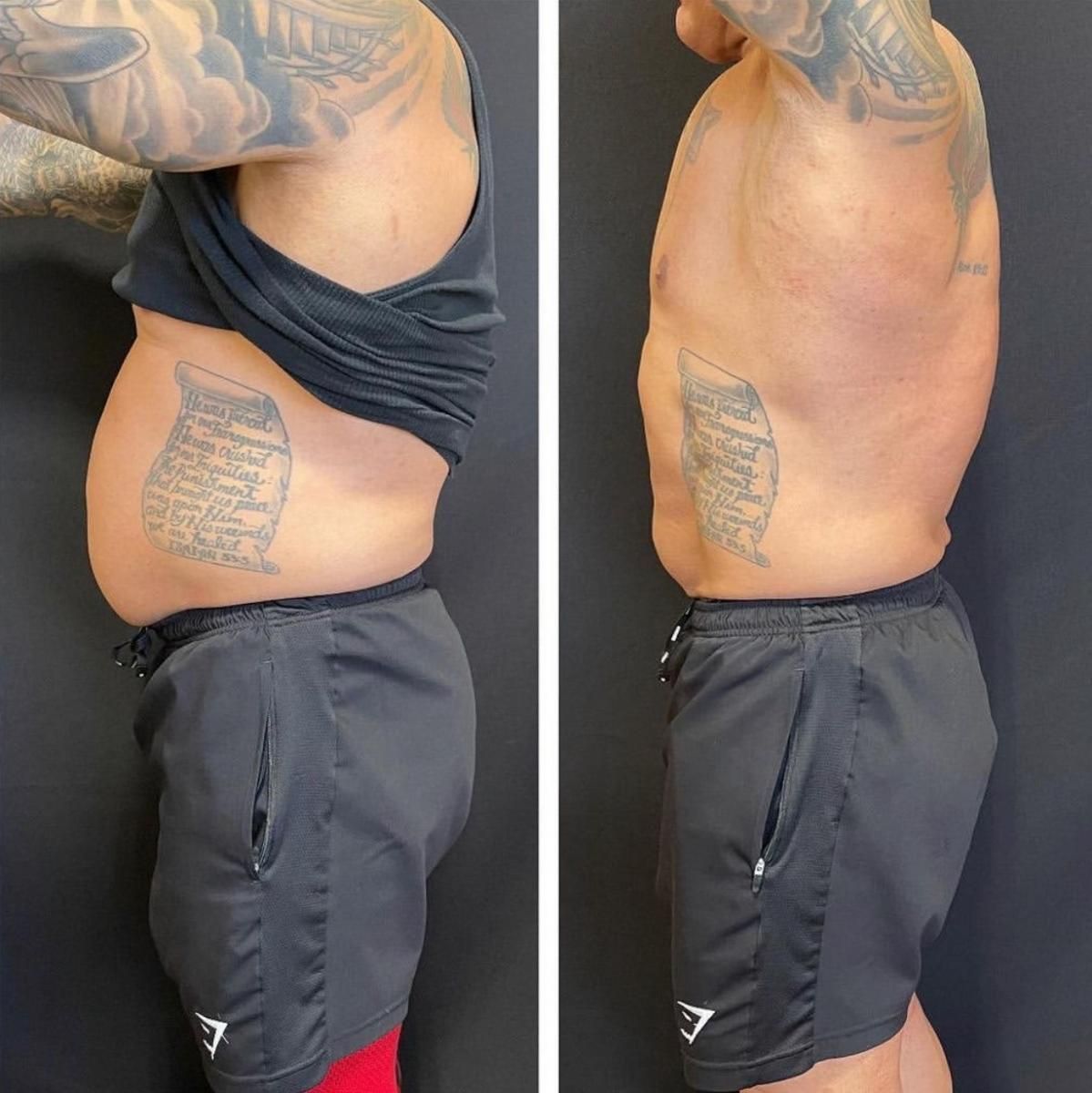 Emsculpt NEO Before & After 20