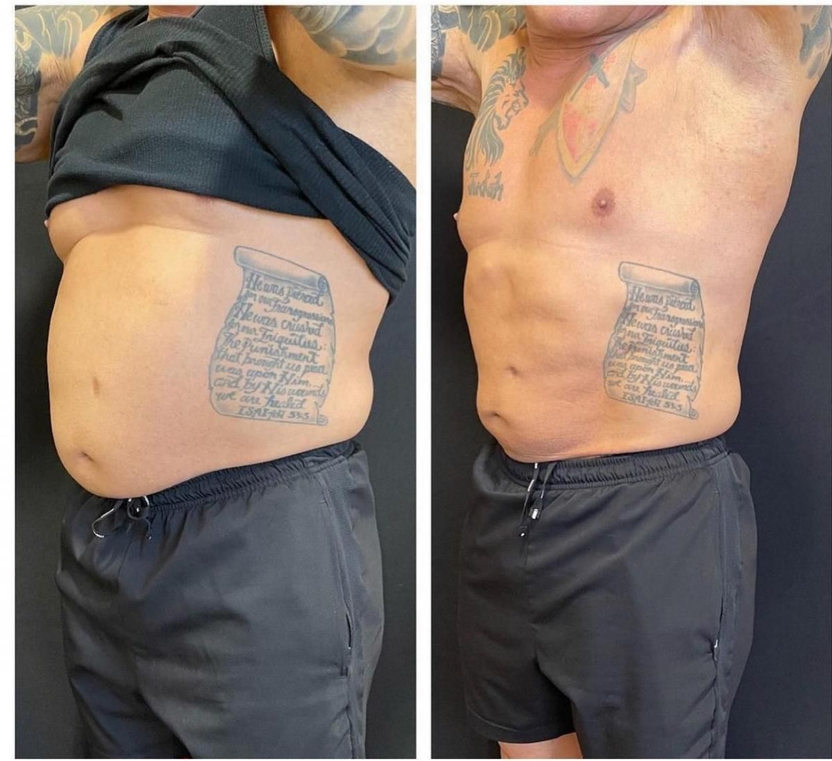 Emsculpt NEO Before & After 21