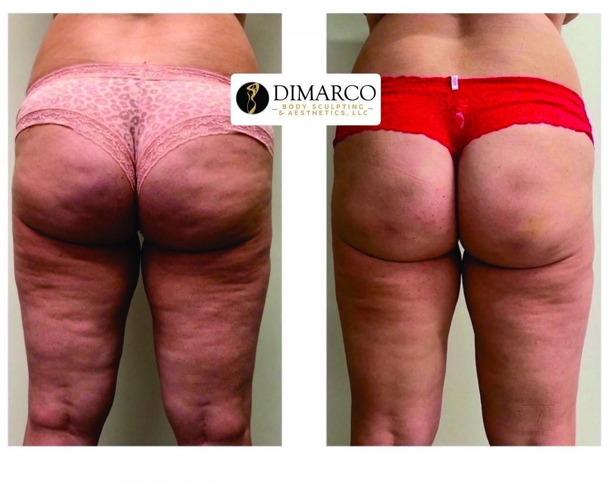 Emsculpt NEO Before & After 22