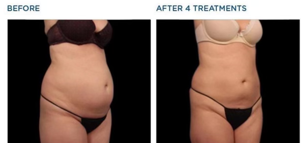 Emsculpt NEO Before & After 30