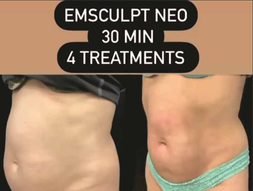 Emsculpt NEO Before & After 6