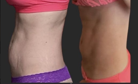 Emsculpt NEO Before & After 7