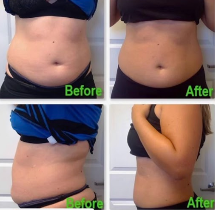 Emsculpt NEO Before & After 9