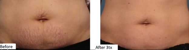 Secret RF Before & After 5