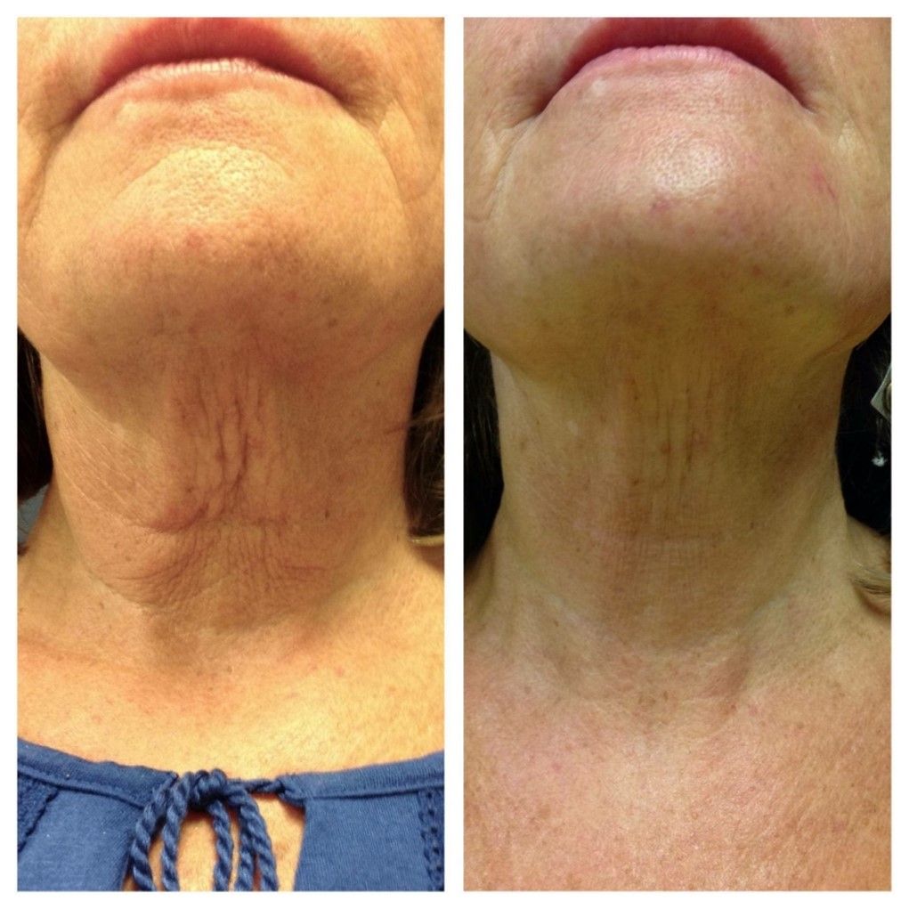 Secret RF Before & After 6