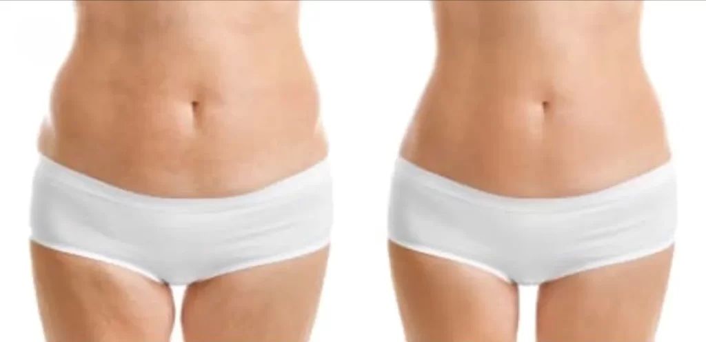 truSCULPT Before & After 1