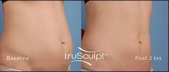 truSCULPT Before & After 3