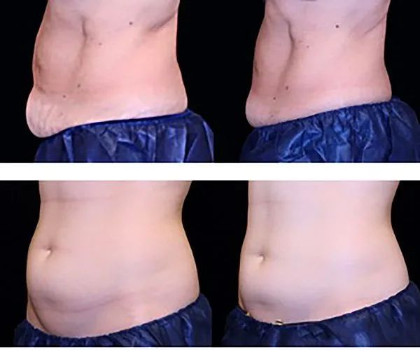 truSCULPT Before & After 5