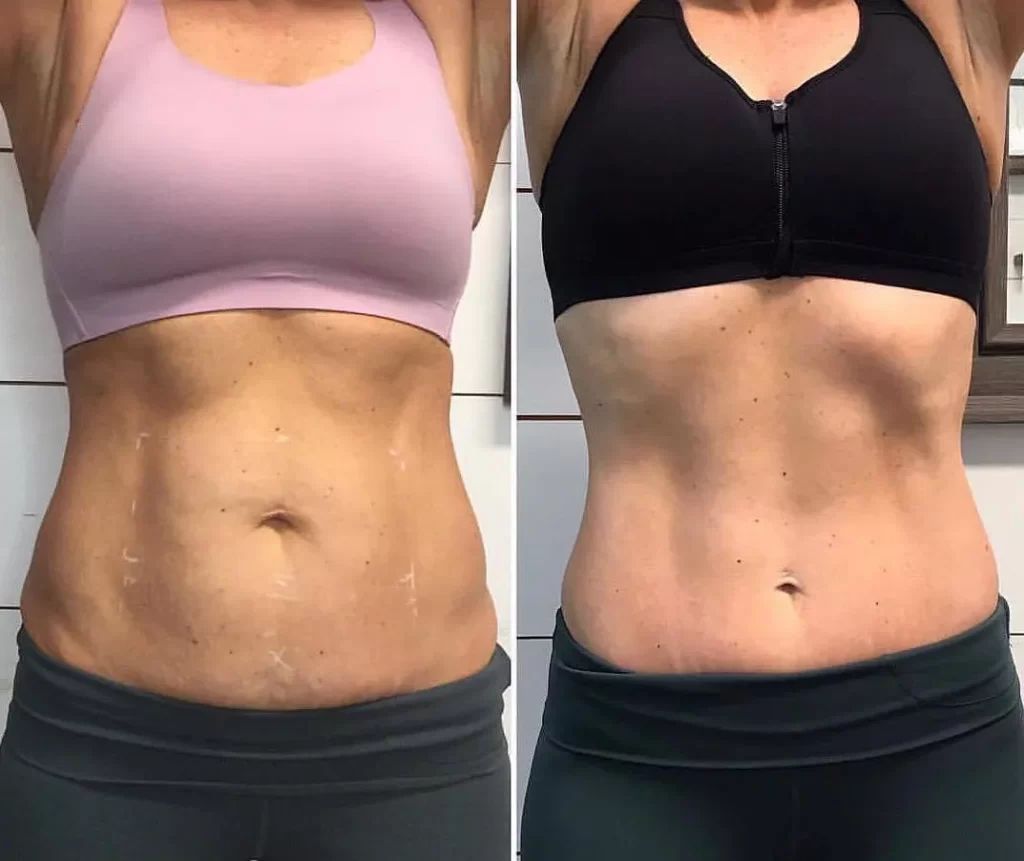 truSCULPT Before & After 7