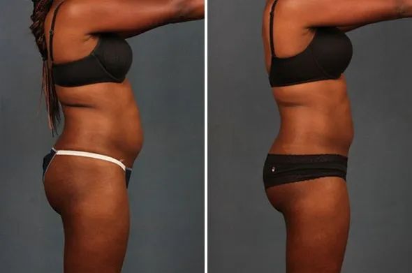 truSCULPT Before & After 8