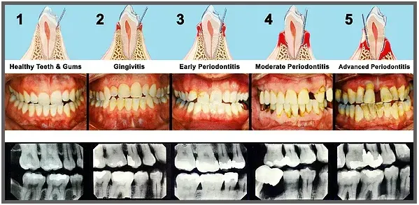 Periodontitis Chart — Lapeer, MI — Lapeer Family Dental