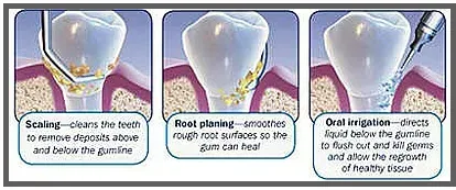 Scaling Chart — Lapeer, MI — Lapeer Family Dental