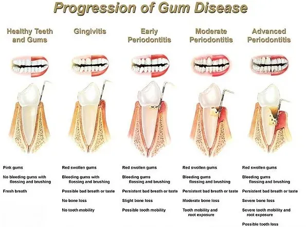 Gum Disease Chart — Lapeer, MI — Lapeer Family Dental