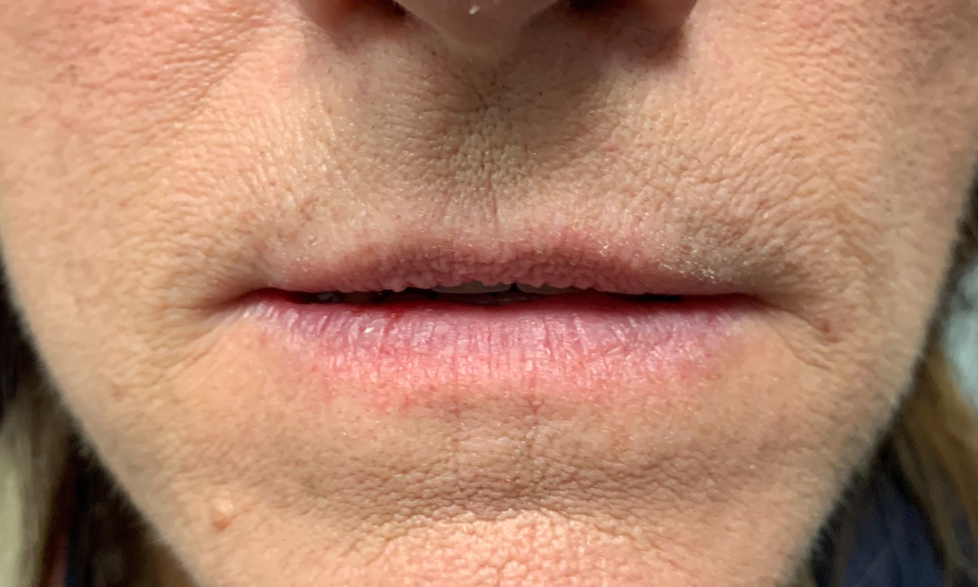 A close up of a woman 's mouth with wrinkles.