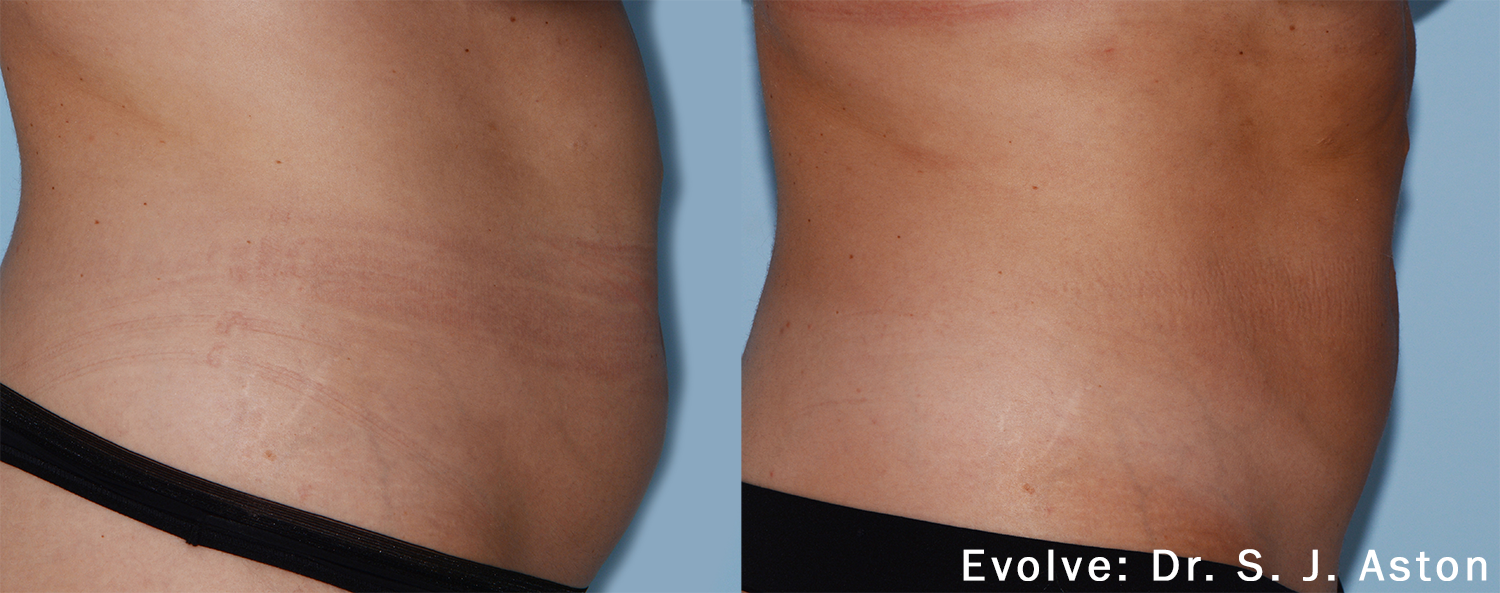 A before and after photo of a woman 's stomach by evolve dr. s. j. aston