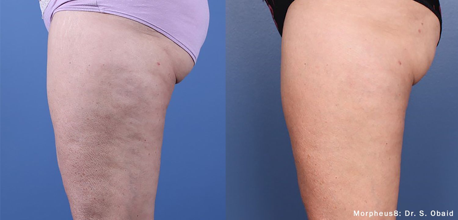 A before and after photo of a woman 's legs with varicose veins.