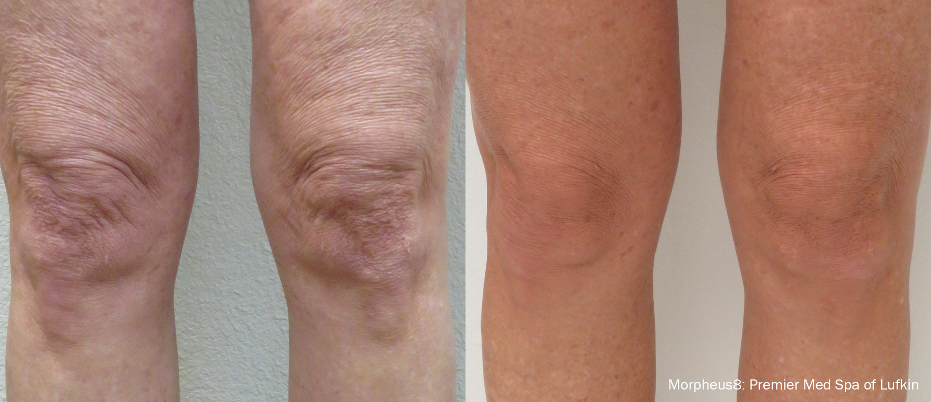 A before and after photo of a person 's knee.