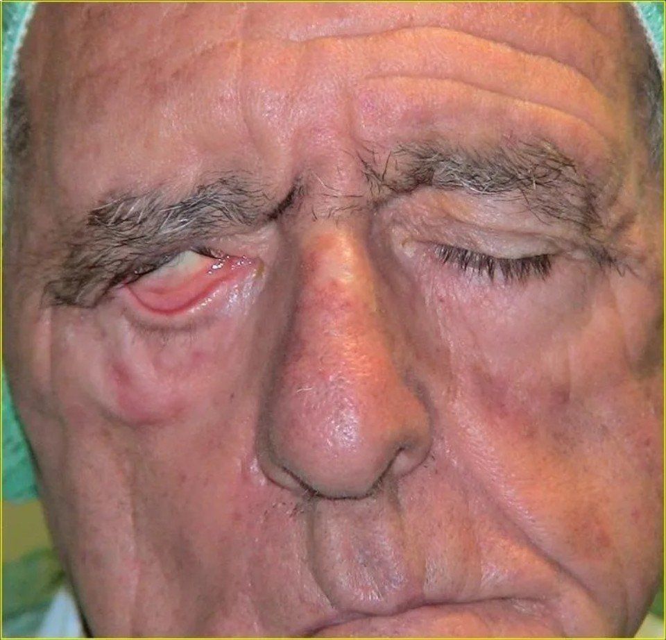 Paralisi del nervo facciale