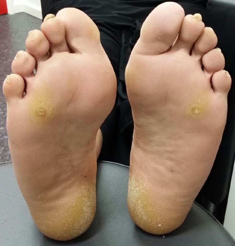 Corn And Callus - Perth, WA - Centrepod Podiatry