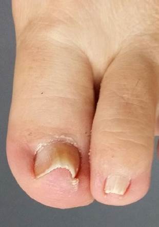 Ingrown Toenail - Perth, WA - Centrepod Podiatry