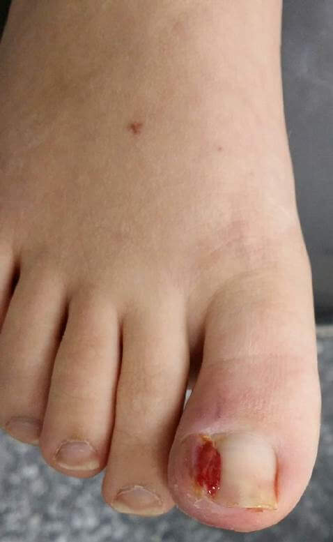 Ingrown Toenail And Blood - Perth, WA - Centrepod Podiatry