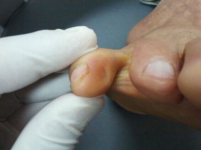 Little Toe Corn - Perth, WA - Centrepod Podiatry