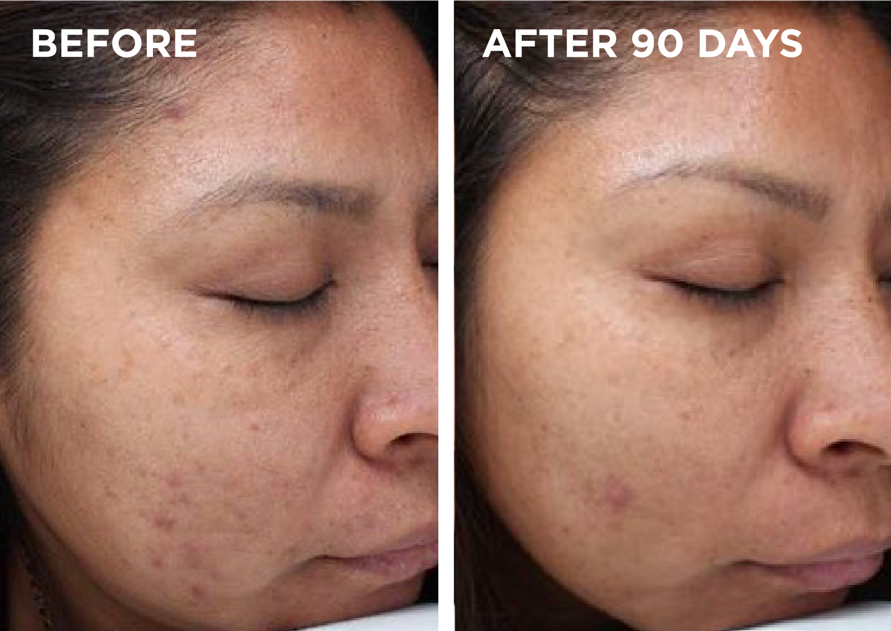 Before and After VI Peel Facial Treatments