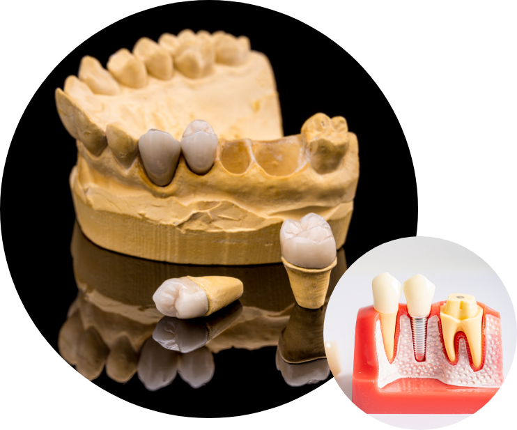 dental implant 4