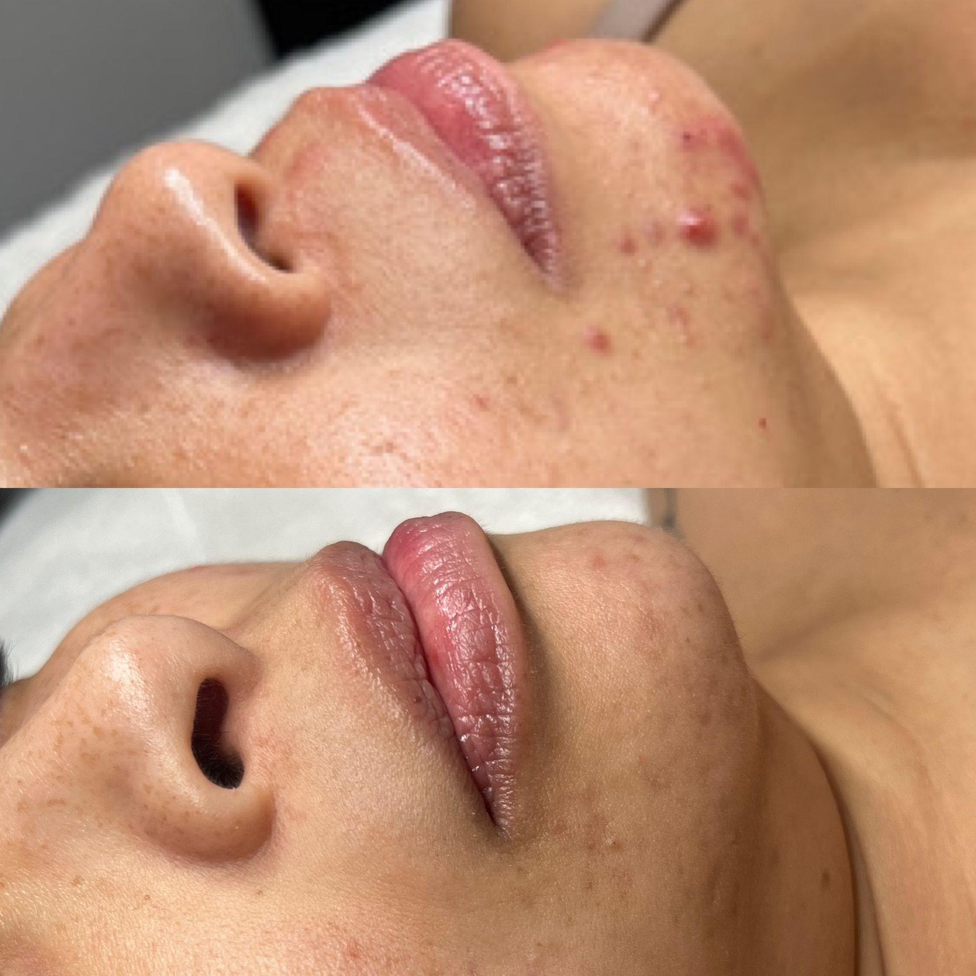 A before and after photo of a woman 's face with acne.