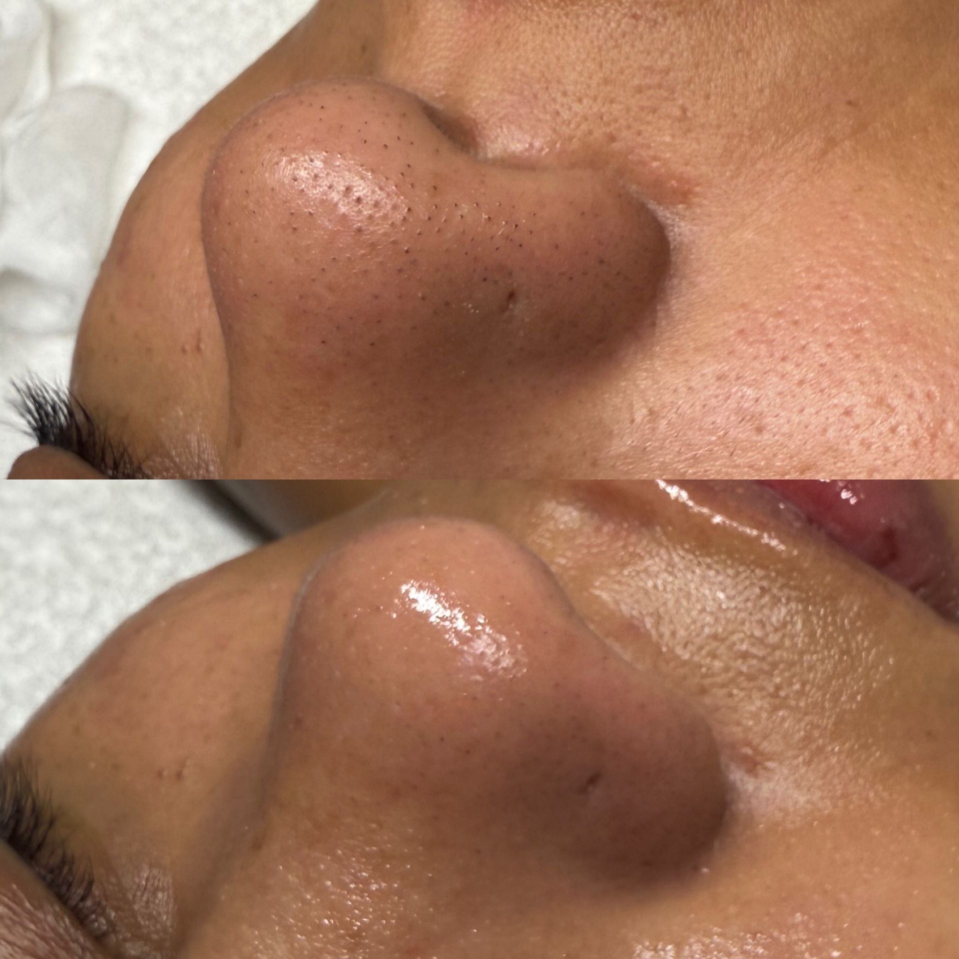 A before and after picture of a woman 's nose.