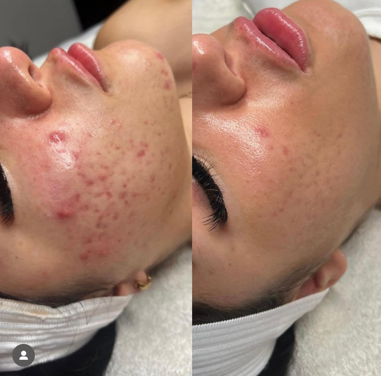 A before and after photo of a woman 's face