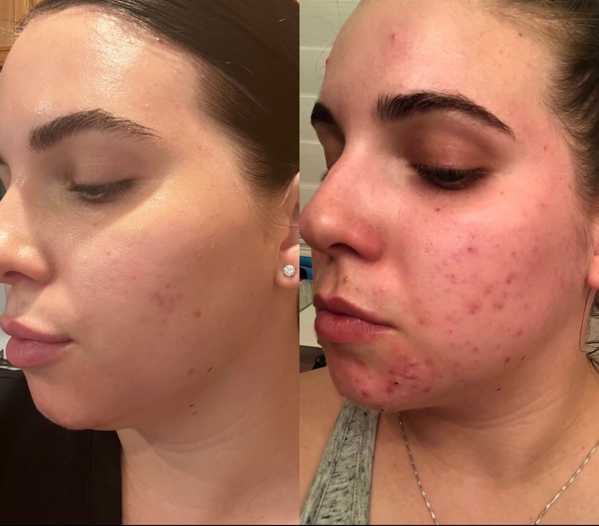 A before and after photo of a woman 's face