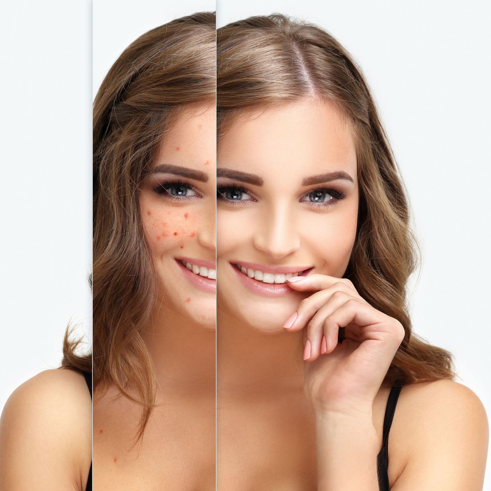 A before and after picture of a woman with acne on her face.