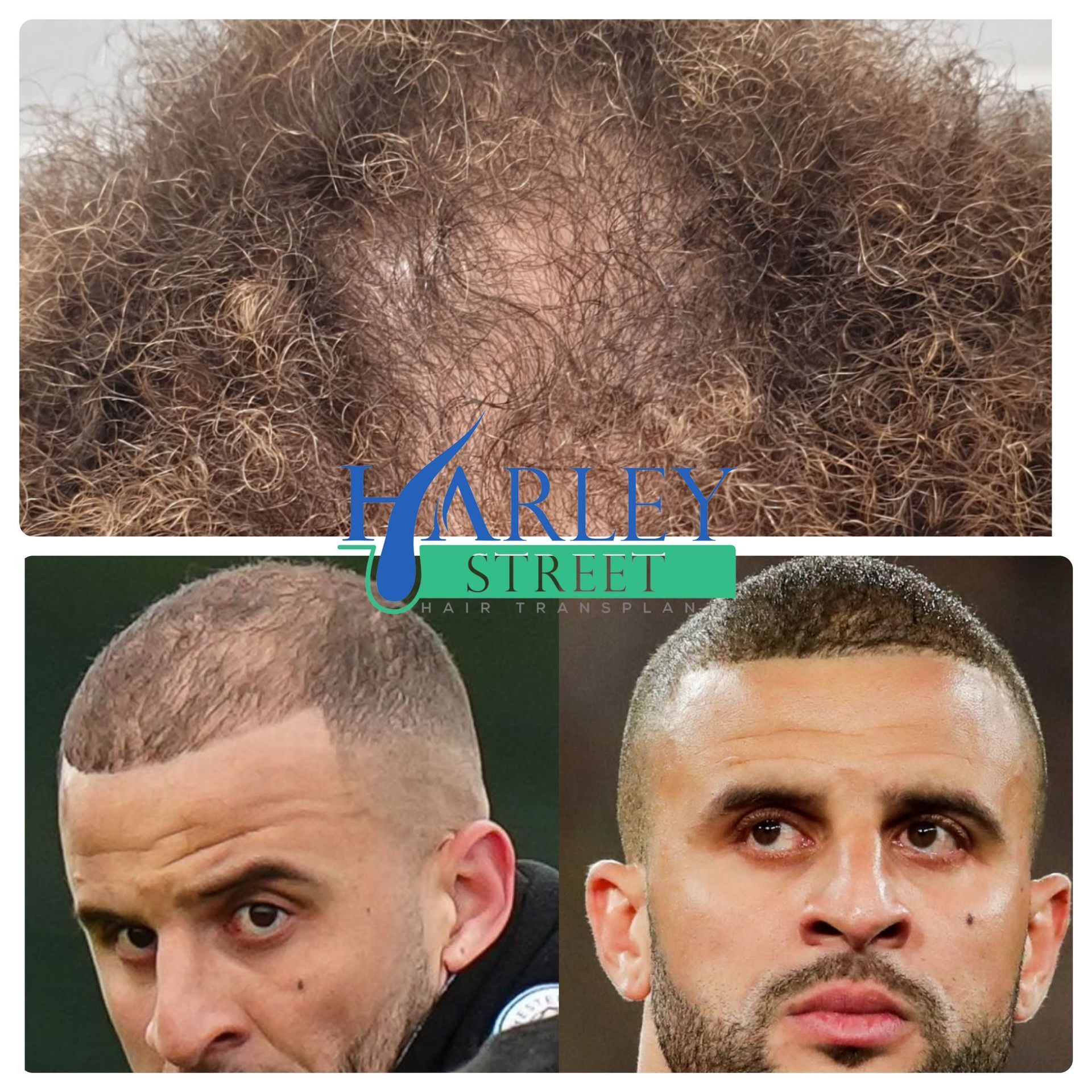 A picture of Kyle Walker before and after a FUE  hair transplant.