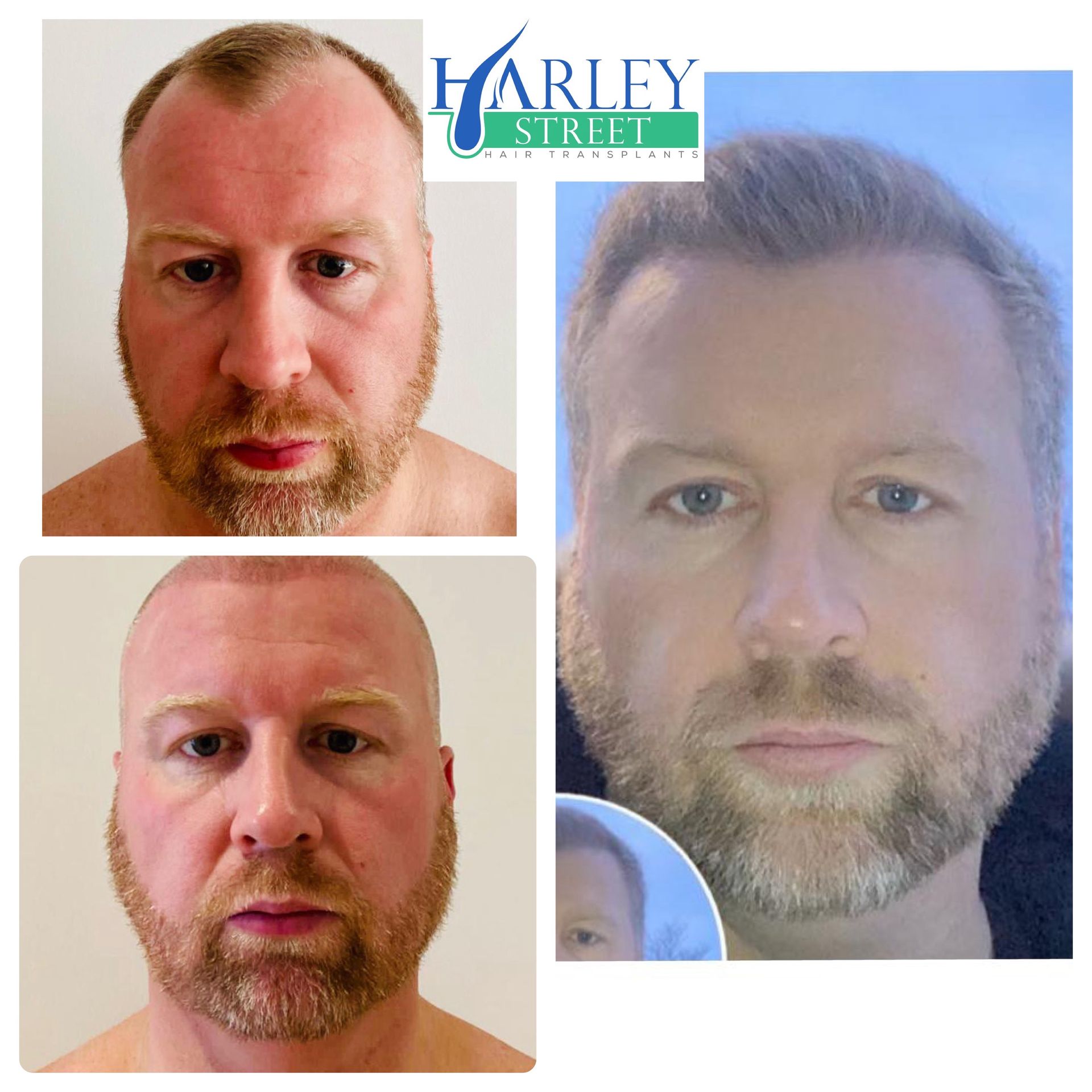 Before and after hair transplant result