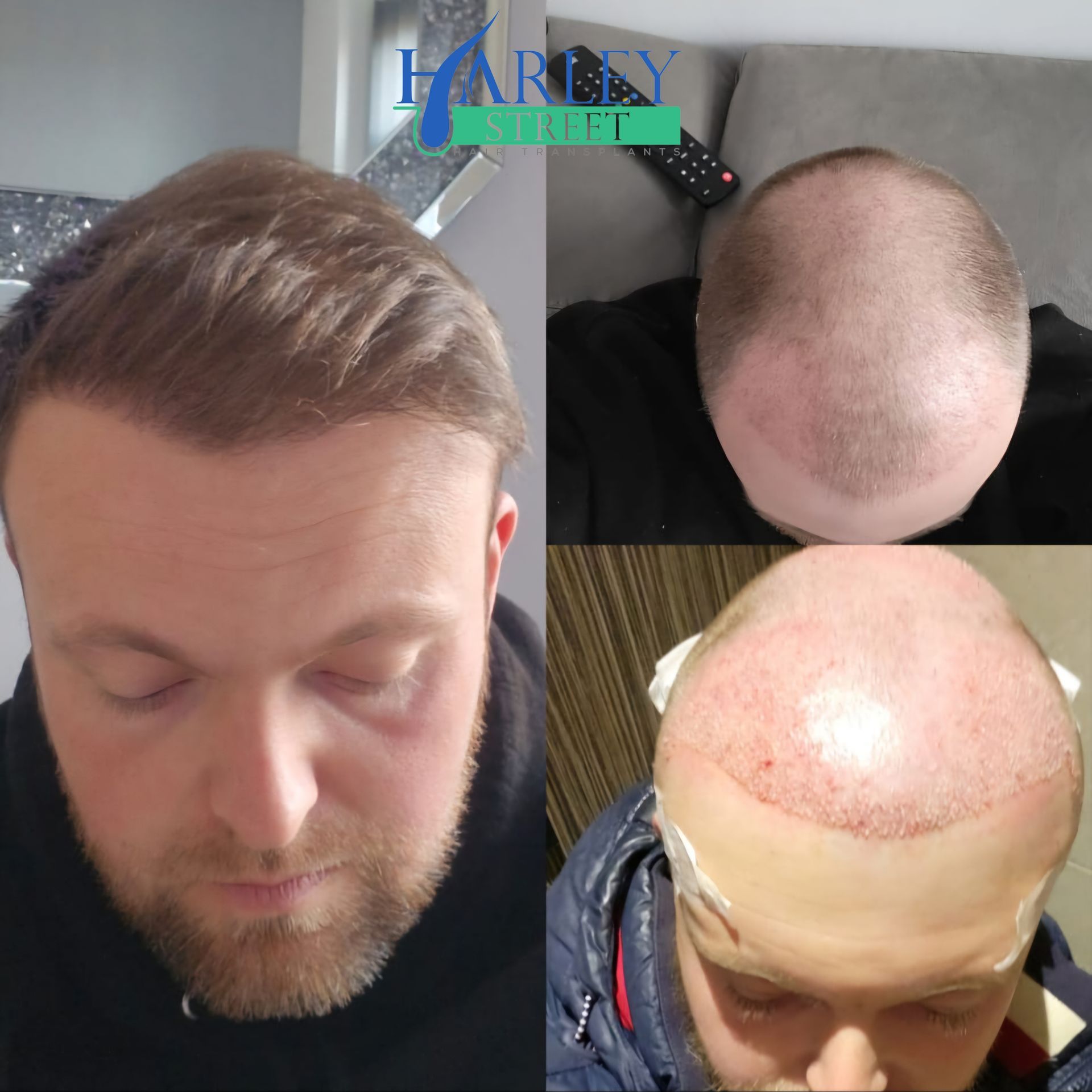 Before and after hair transplant result
