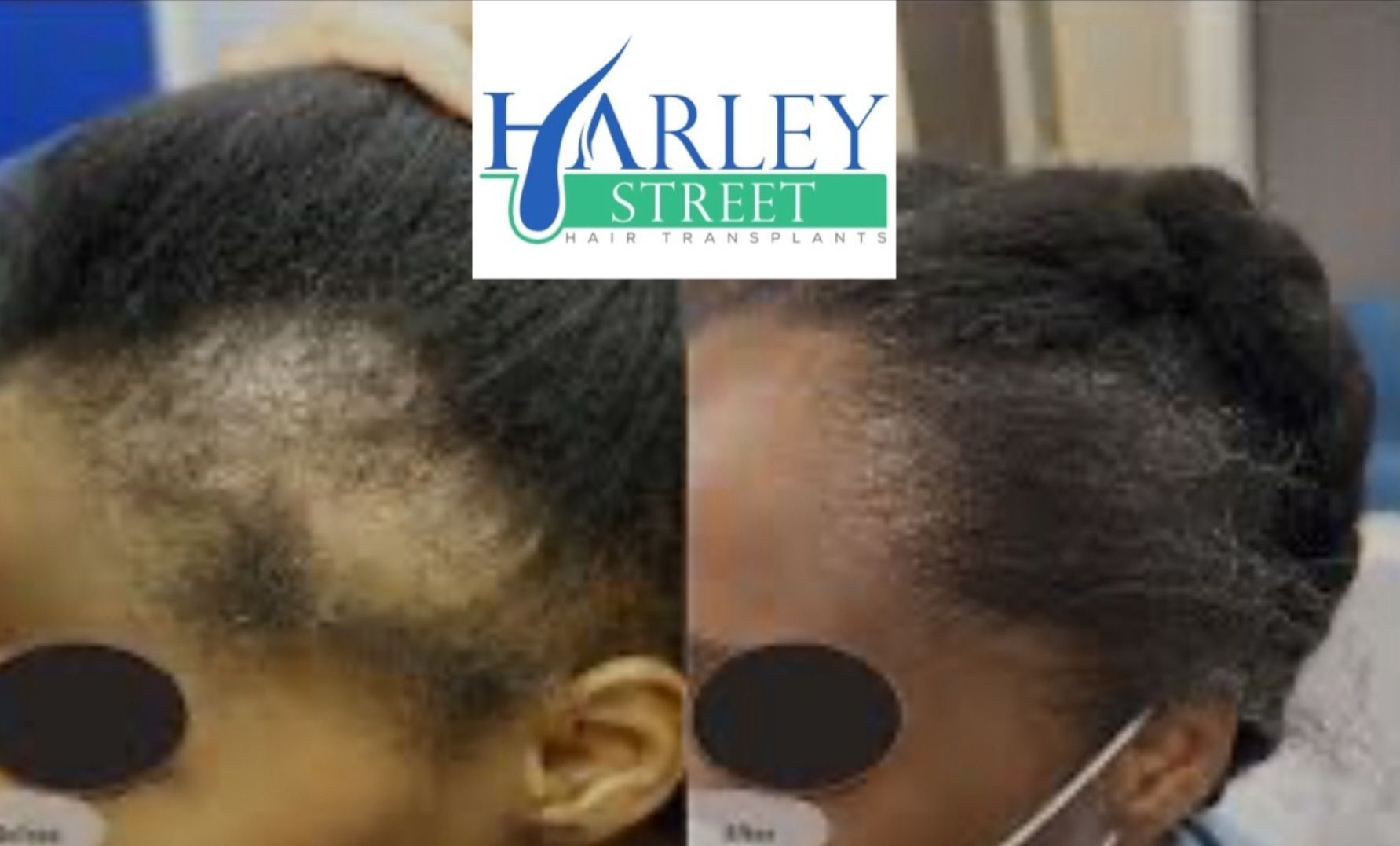 Afro hair transplant result example