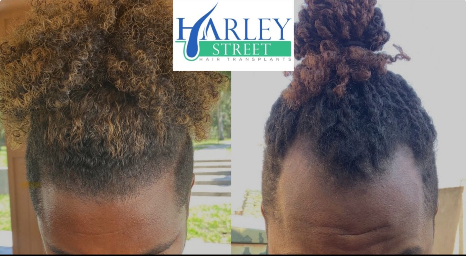 Afro hair transplant example