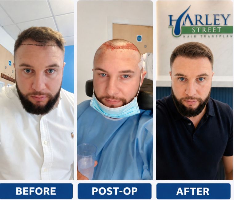 Image of a man after hsi FUE hairline hair transplant 