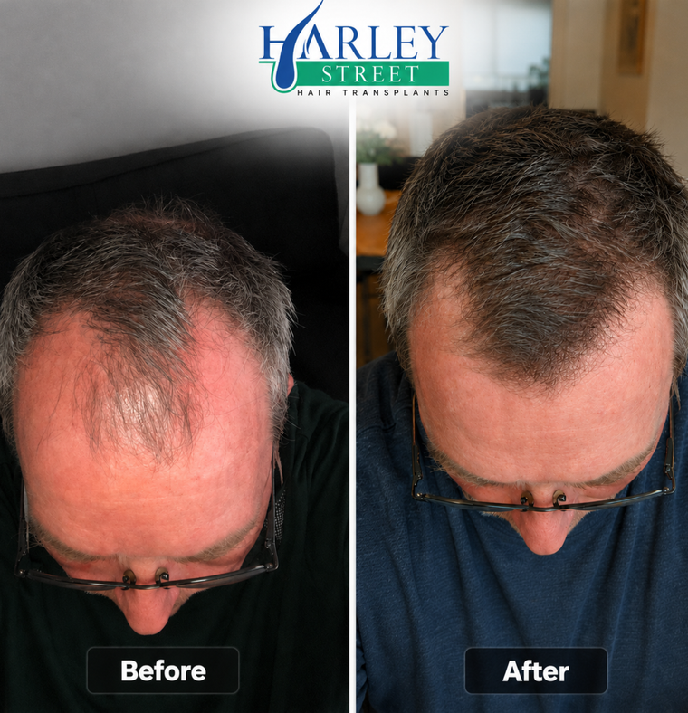 Image of a man after hsi FUE hairline hair transplant 