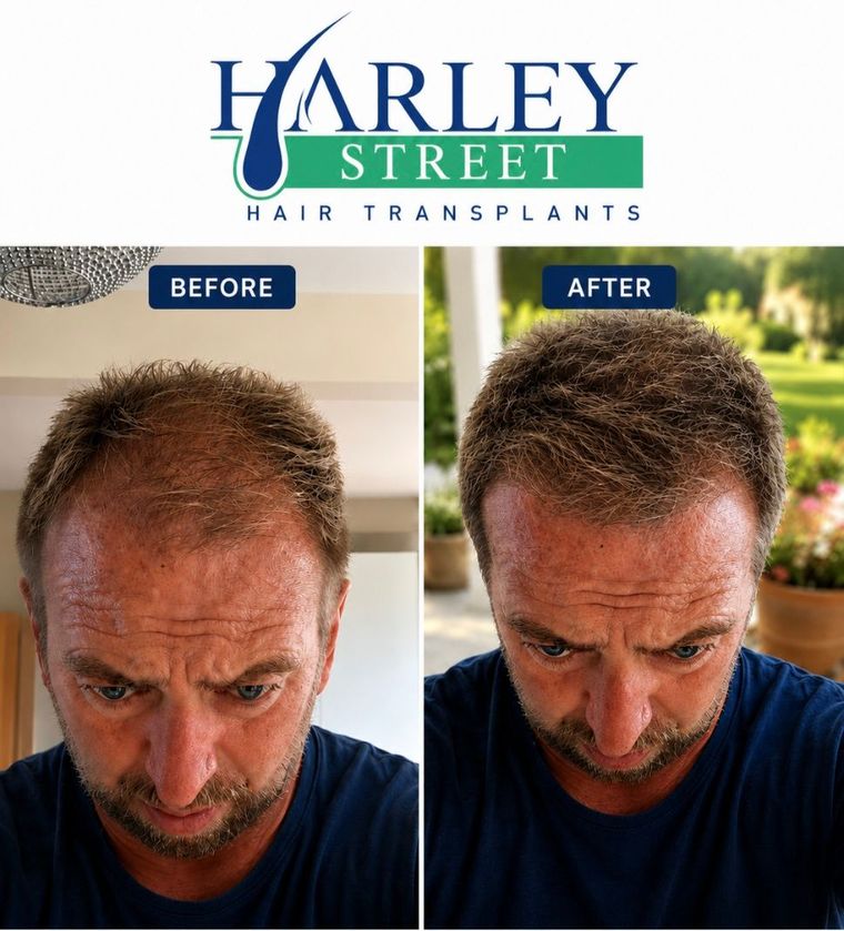 Image of a man after hsi FUE hairline hair transplant 