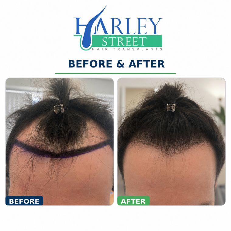 Image of a man after hsi FUE hairline hair transplant 