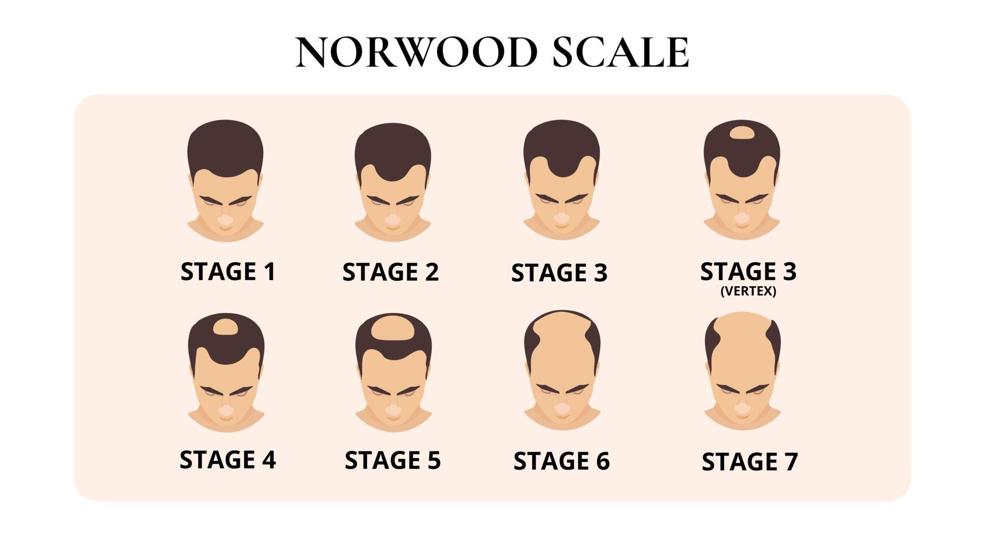 Norwood stages hair loss scale showing male pattern baldness stages 1 to 7